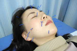 岡崎アオイ鍼灸接骨院では美容鍼や花粉症対策可能です